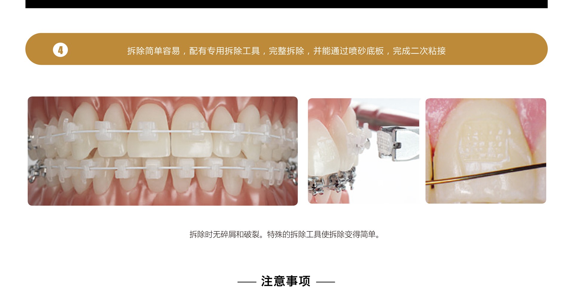 美容牙科正畸牙科金属丝牙托槽教学学生模式。照片摄影图片_ID:300154801-Veer图库